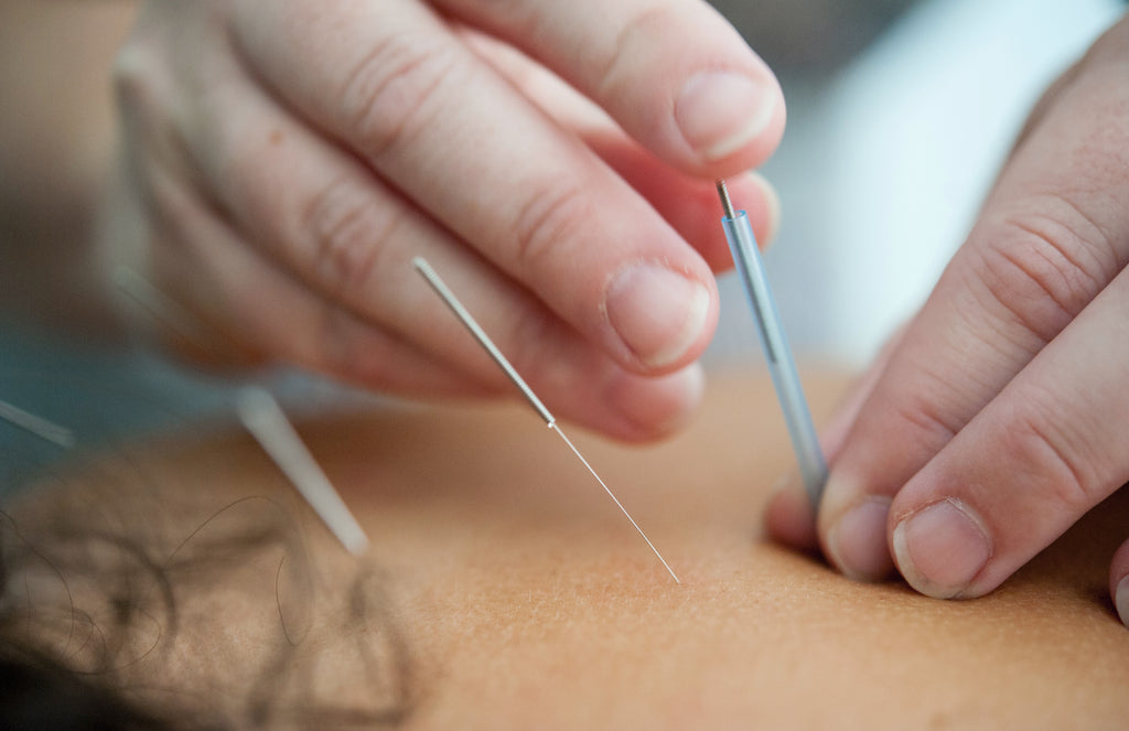 How Acupuncture can Help with Weight Loss, Sciatica Pain, Anxiety, and Depression